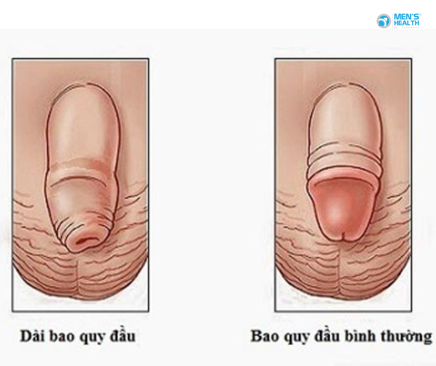 Lật Tẩy Những Lời Đồn Vô Căn Cứ Về Bao Quy Đầu Và Sự Thật Bạn Cần Biết