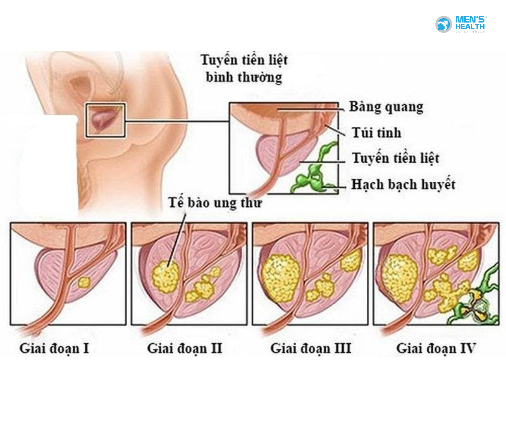 Chẩn Đoán Ung Thư Tuyến Tiền Liệt: Từ Dấu Hiệu Thầm Lặng Đến Tiếp Cận Hệ Thống