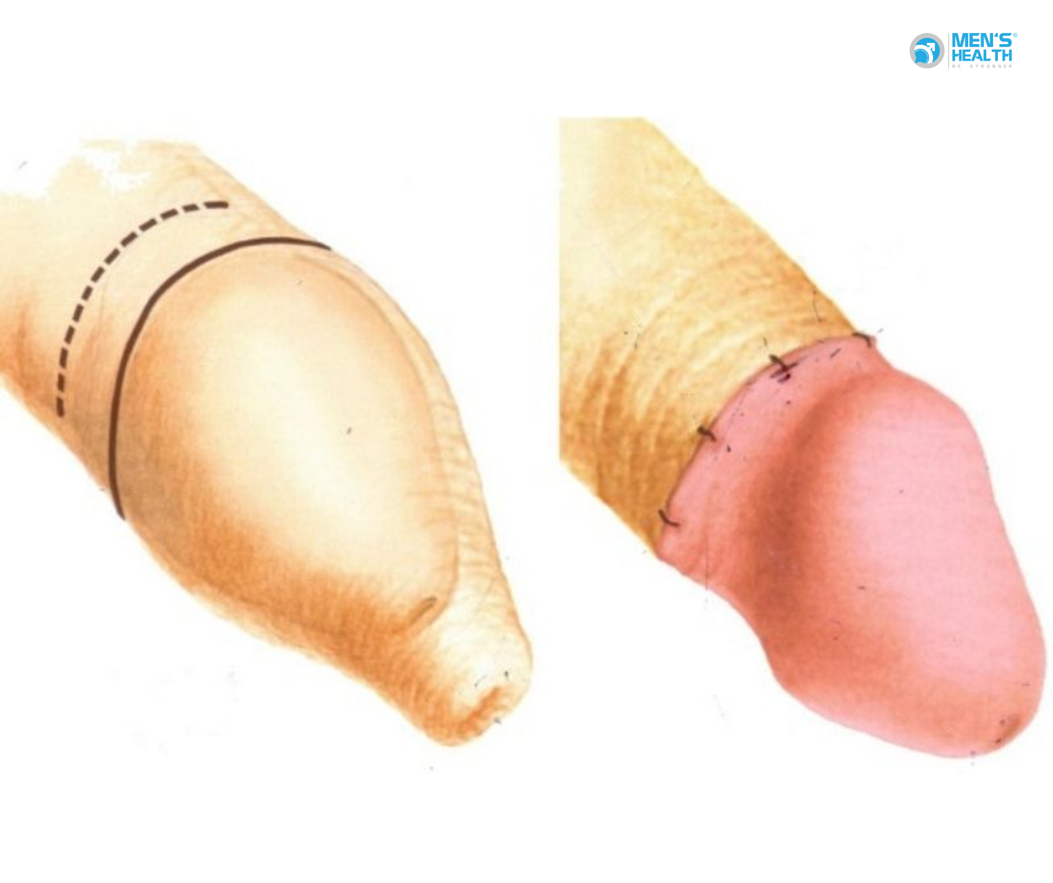 Cắt Bao Quy Đầu Có Thực Sự Làm Giảm Khoái Cảm Tình Dục?