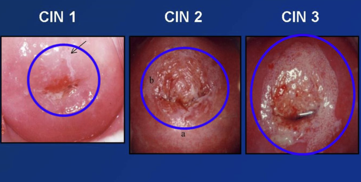 U Tân Sinh Không Chắc Chắn Hoặc Không Biết Tính Chất Của Cơ Quan Sinh Dục Nam (D40)