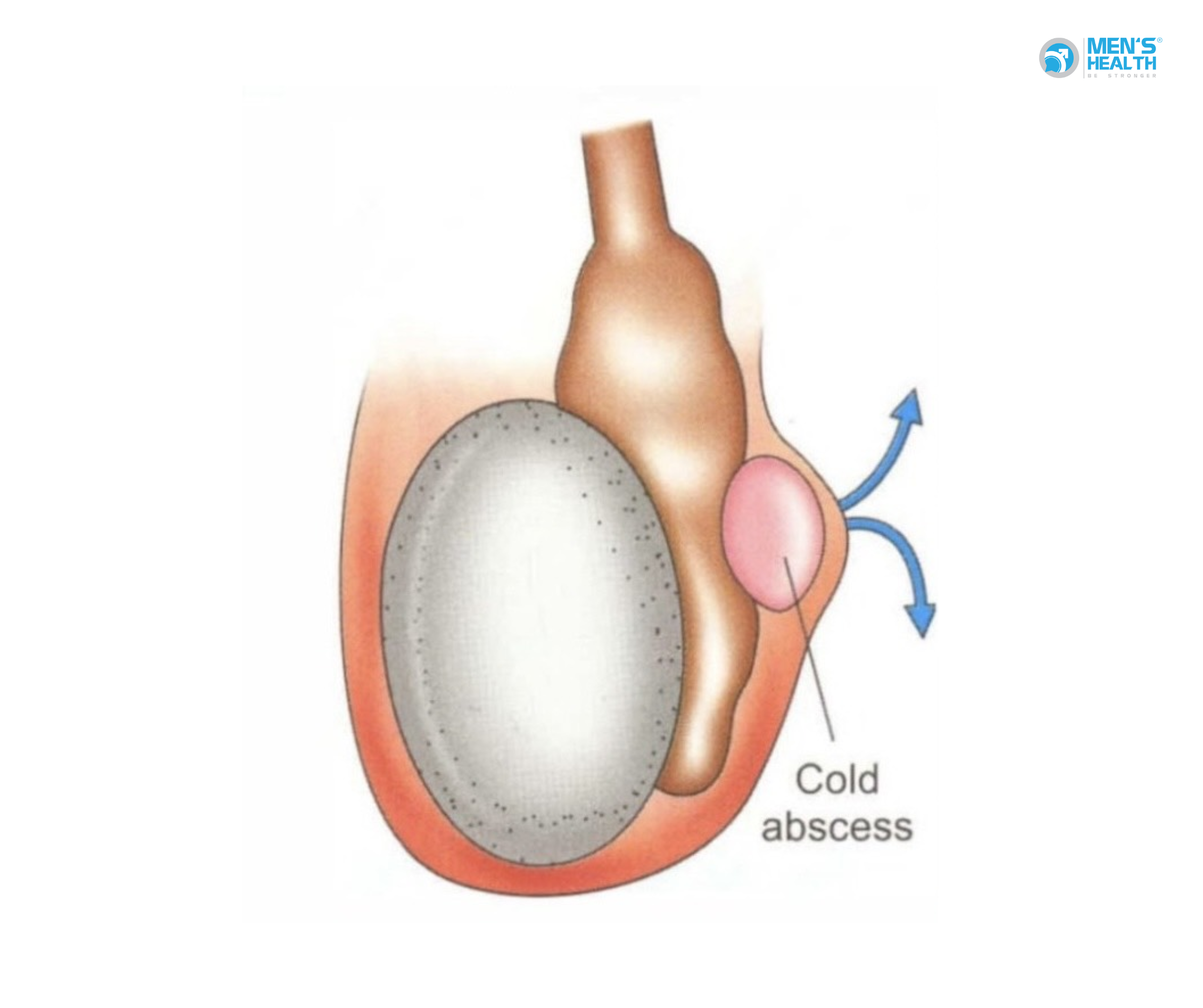Lao Mào Tinh Hoàn – Căn Bệnh Âm Thầm Nhưng Có Thể Khiến Quý Ông Vô Sinh