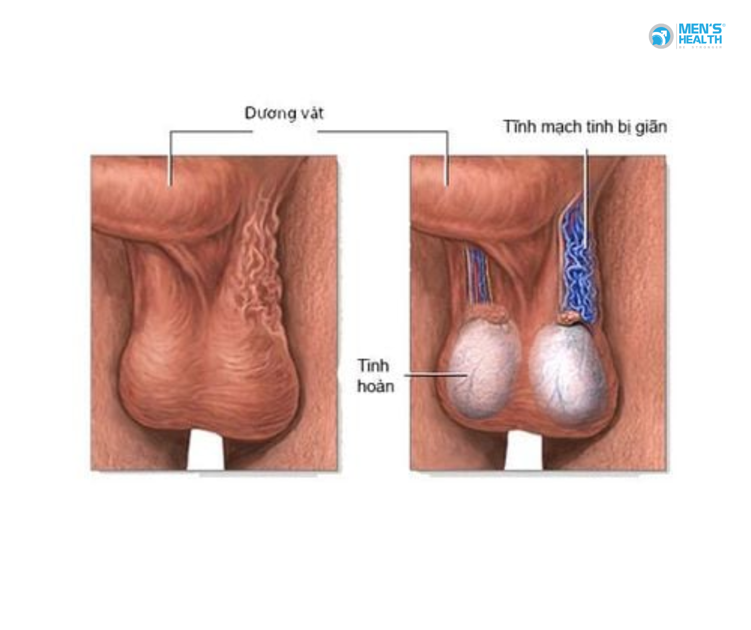 Điều Trị Suy Sinh Dục Nam Có Giãn Tĩnh Mạch Thừng Tinh