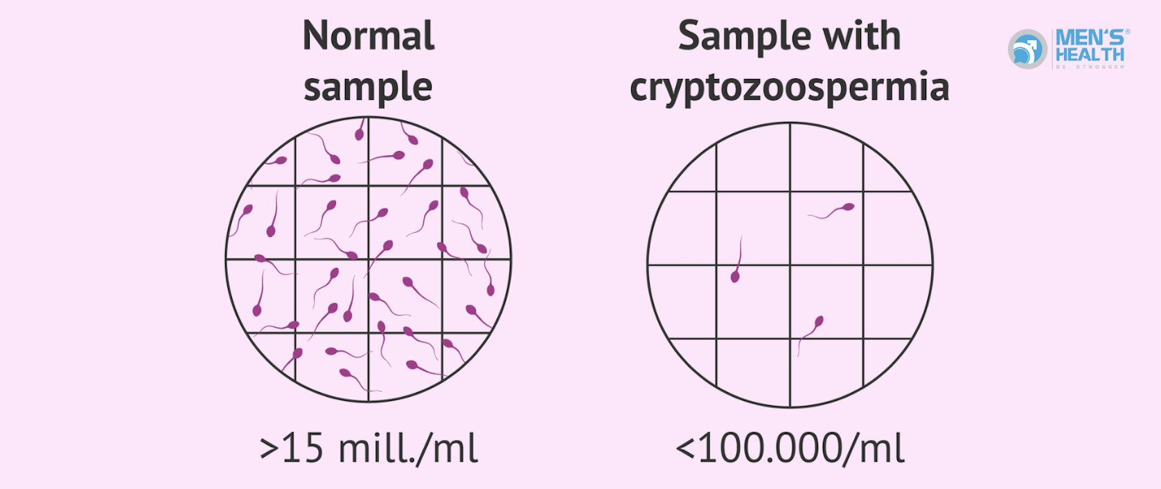 Cryptozoospermia: Phẫu Thuật Hay Không Phẫu Thuật Trong Hỗ Trợ Sinh Sản?